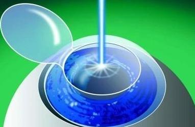 激光视力矫正手术后会再次近视吗,激光矫正近视多少岁能够矫正