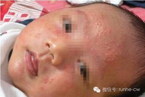 宝宝脸上总起红疙瘩是什么原因,宝宝脸上突然起红疙瘩怎么办