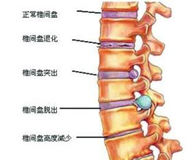 倒着走能够治疗腰间盘突出吗,腰间盘突出倒着走多长时间