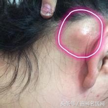 恶性肿瘤身上有很多包是咋回事,恶性肿瘤转移身上很多包块