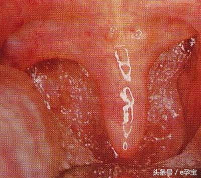 扁桃体炎民间简便偏方,儿童咽喉炎食疗小偏方