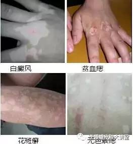 白癜风的鉴别诊断,白癜风的鉴别诊断有哪些