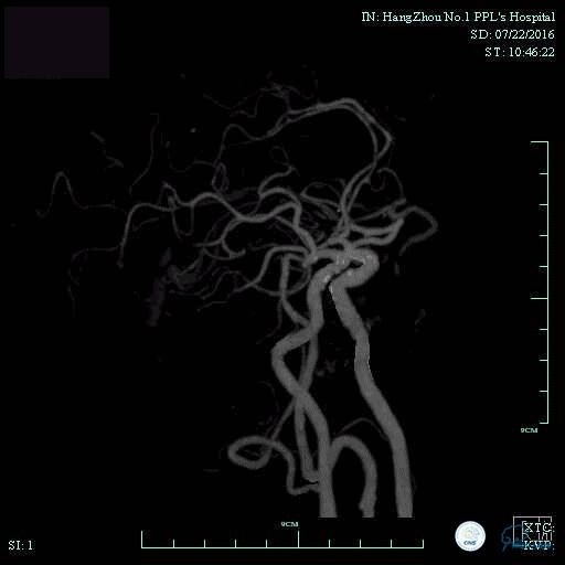 CINS2016病例展｜一例双侧大脑前动脉栓塞的再通治疗