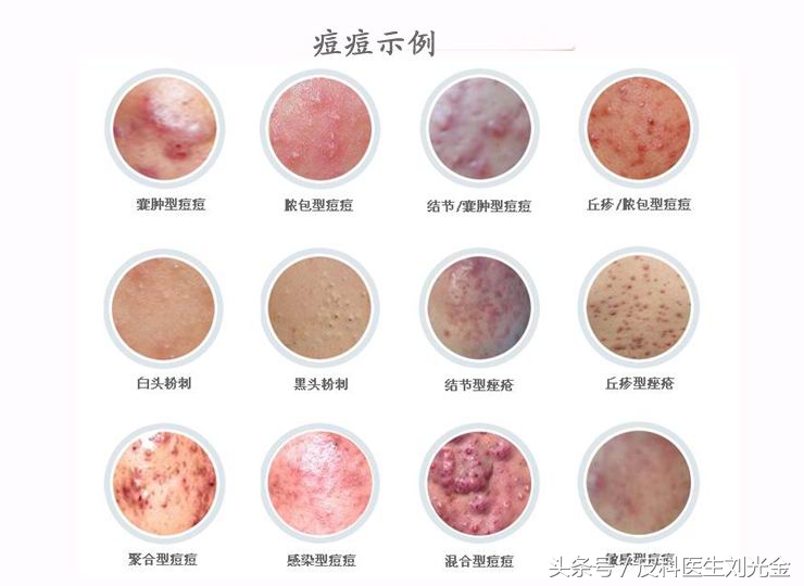 治疗痤疮最新研究进展,治疗青春痘最新视频