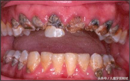 如何从牙齿上判断小孩是否铅中毒,大人口腔细菌对宝宝危害真实案例