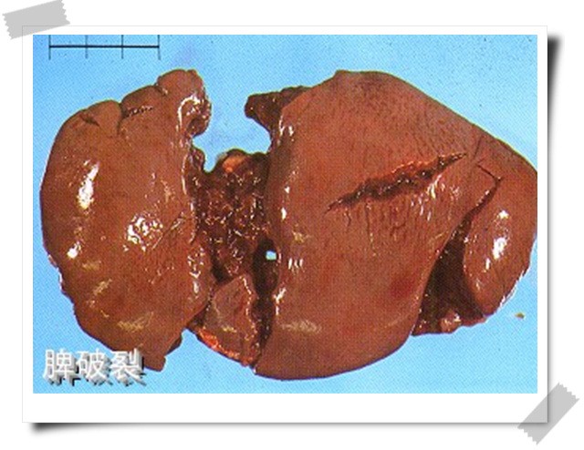 不作死就不会死，这个小哥终于把自己脾脏作掉了