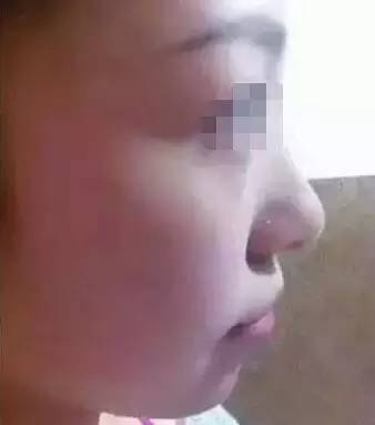 玻尿酸填充下巴一针还是两针好,玻尿酸丰下巴后要注意哪些问题