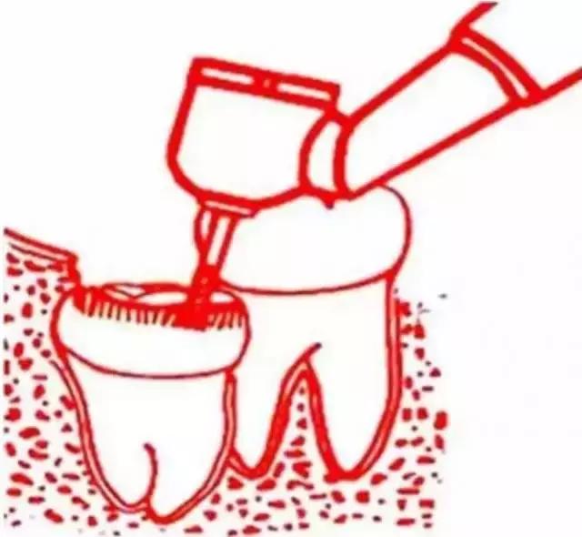 智齿的治疗过程,智齿要上下成对拔除吗