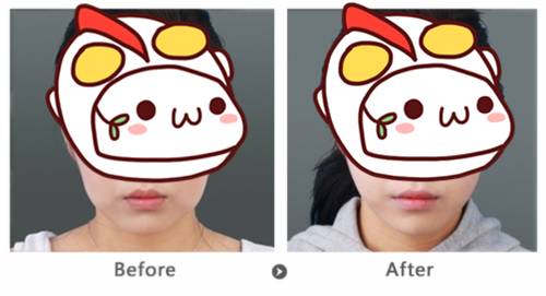 玻尿酸填充下巴一针还是两针好,玻尿酸丰下巴后要注意哪些问题