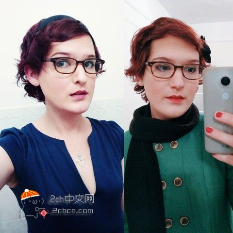 秃头大叔服用雌性激素,秃头男吃雌激素一年