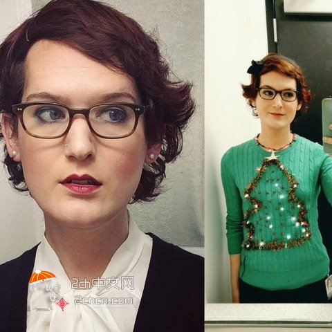 秃头大叔服用雌性激素,秃头男吃雌激素一年