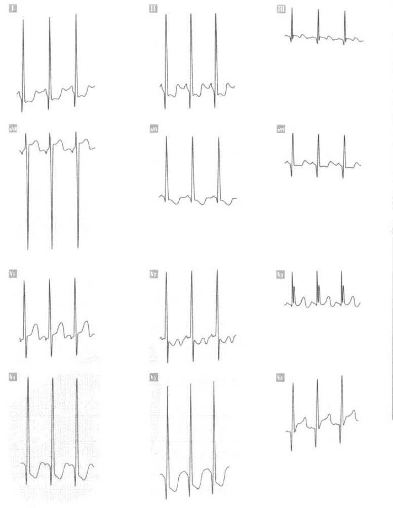 心电图出现异常q波说明心肌缺血,心电图v1v2q波异常严重吗