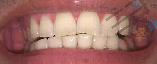 亲身体验清洁效果,洗牙体验全视频