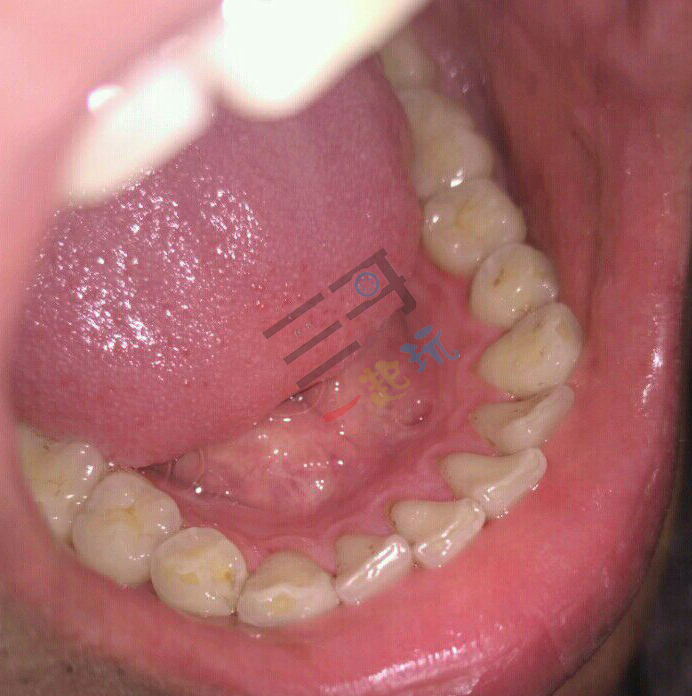 亲身体验清洁效果,洗牙体验全视频