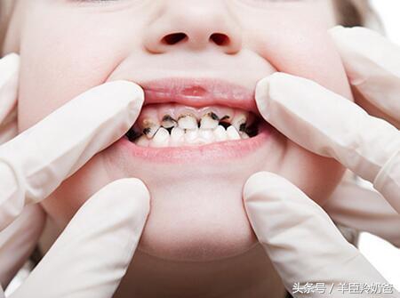 六龄齿坏了还换牙吗,怎样保护孩子的六龄齿