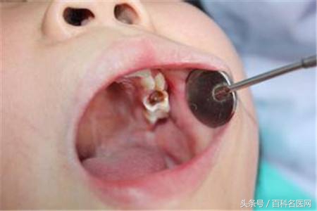 牙齿疼到牙髓吃什么药物治疗,牙髓痛怎么办教你快速止牙痛