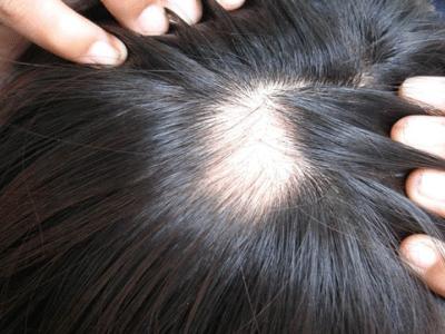 中医掉头发的治疗方法,掉头发严重怎么调理最有效中医
