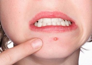 下巴长痘痘的原因和解决方法,内分泌失调下巴长痘痘吃什么药