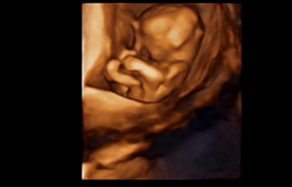 b超查出来宝宝兔唇怎么办,b超照出胎儿有兔唇