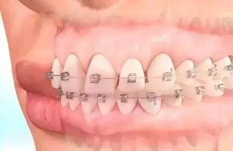 如何一秒钟矫正牙齿,牙齿矫正让你悄然改变从现在开始