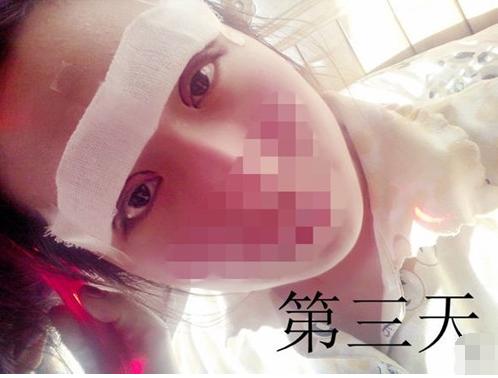 长期用双眼皮胶水变松,长期用胶水粘双眼皮的后果