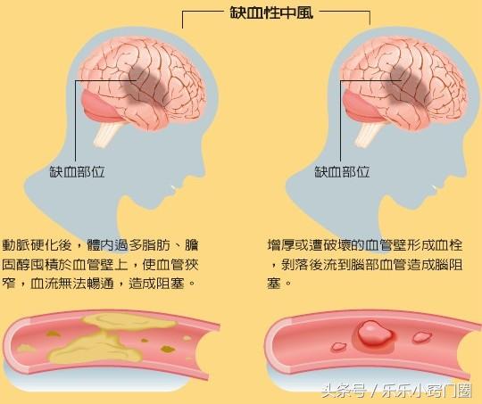 三七对脑梗塞功效与功能,脑梗塞吃药能够吃三七吗