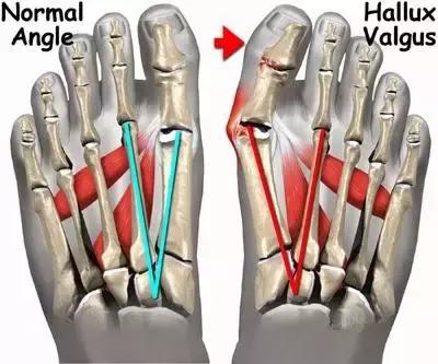 高跟鞋还是少穿吧，许多明星的高颜值，都毁在了一双脚上！