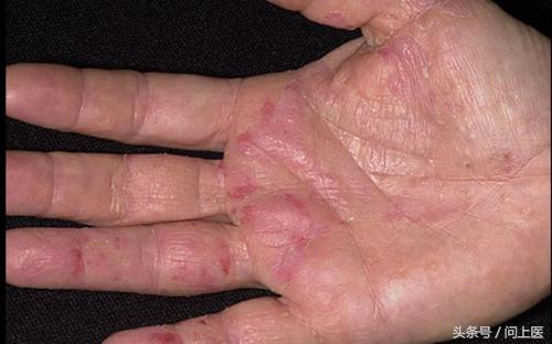 人常见的皮肤病,十二种最常见的皮肤问题对照图