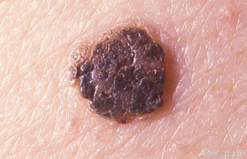 人常见的皮肤病,十二种最常见的皮肤问题对照图