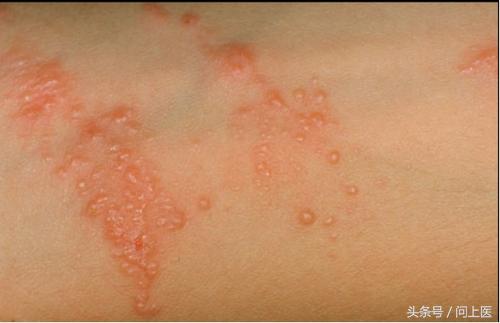 人常见的皮肤病,十二种最常见的皮肤问题对照图