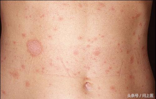 人常见的皮肤病,十二种最常见的皮肤问题对照图