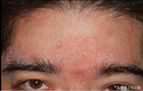 人常见的皮肤病,十二种最常见的皮肤问题对照图
