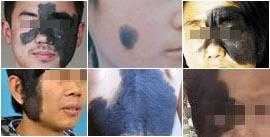 切除黑毛痣有什么危害,黑毛痣对身体的危害