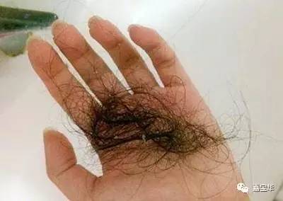 健身脱发是什么原因导致的,两鬓脱发什么原因导致的