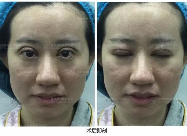 长期使用双眼皮胶水再去割双眼皮,长期用双眼皮胶水能变成永久性吗