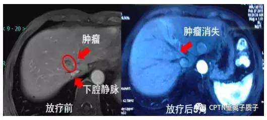 目前质子重离子治疗,2020年中国质子重离子有哪些医院