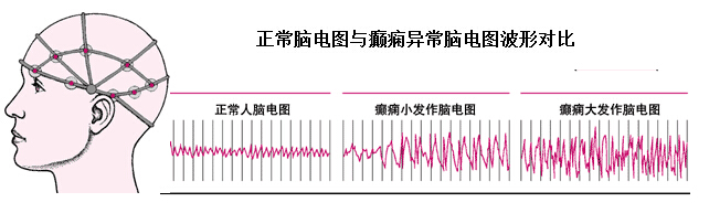 孩子发烧脑电图异常什么原因,9岁小孩脑电图异常怎么办