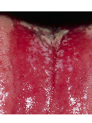 柯萨奇病毒怕不怕热,柯萨奇病毒又称为手足口对不对