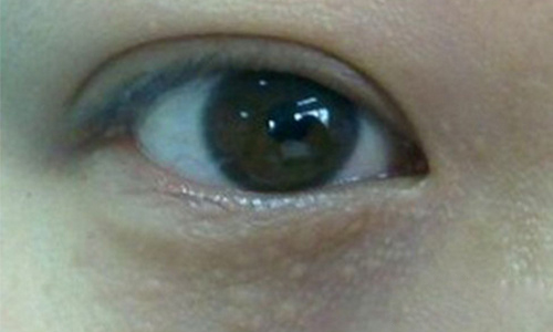 长脂肪粒是皮肤屏障受损吗,长脂肪粒是因为胖吗