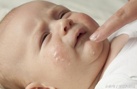 宝宝出麻疹的三大症状和治疗方法,小孩种麻疹疫苗后出现麻疹症状