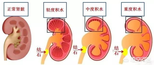 输尿管结石快要掉下来的前兆疼痛,得了结石不治疗会怎样