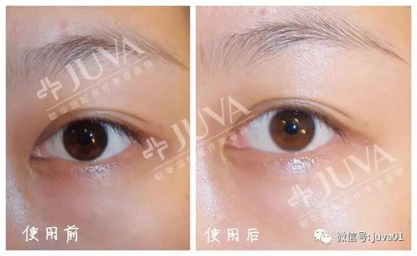 你的黑眼圈怎么去的,4招教你缓解黑眼圈远离熊猫眼