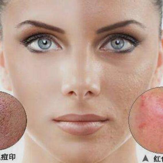 去痘印最有效简单的方法,祛痘印最简单有效的方法