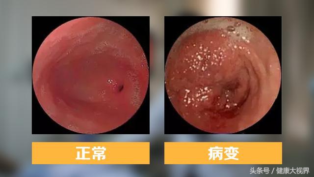 老人胃炎能康复吗,专治老年人的胃病药方