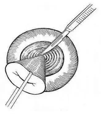 宫颈癌前病变cin2治愈率,宫颈管内癌前病变属于cin么