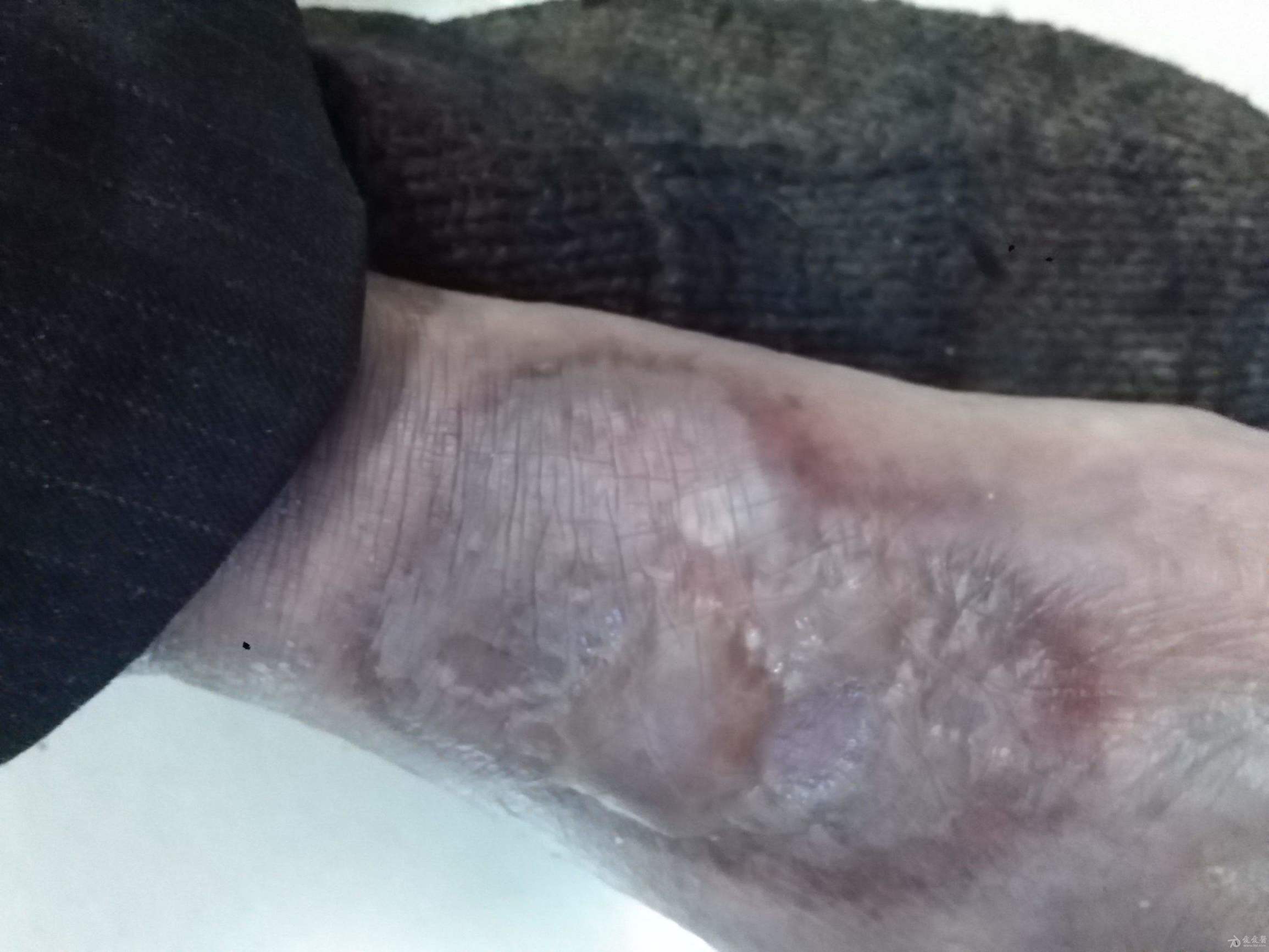 过敏性紫癜的症状,过敏性紫癜性肾炎的诊治