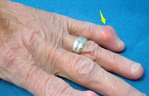 治痛风的偏方急性,治疗痛风的中医外治法请按需收藏