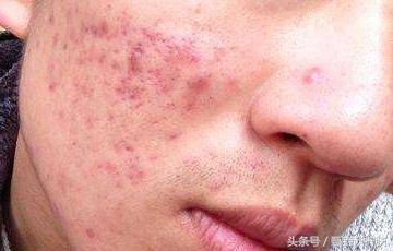 如何祛除痘印男性,如何祛除痘印男生