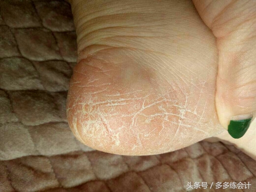脚干裂开刀有什么好办法 (请问行家脚干裂怎么治)