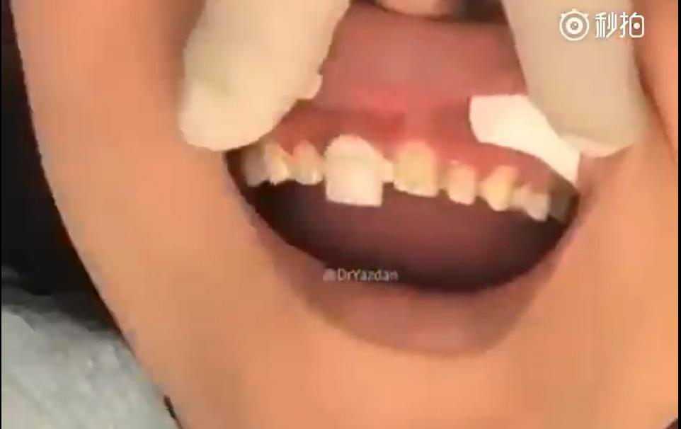 美容冠的副功能,美容冠真实缺点